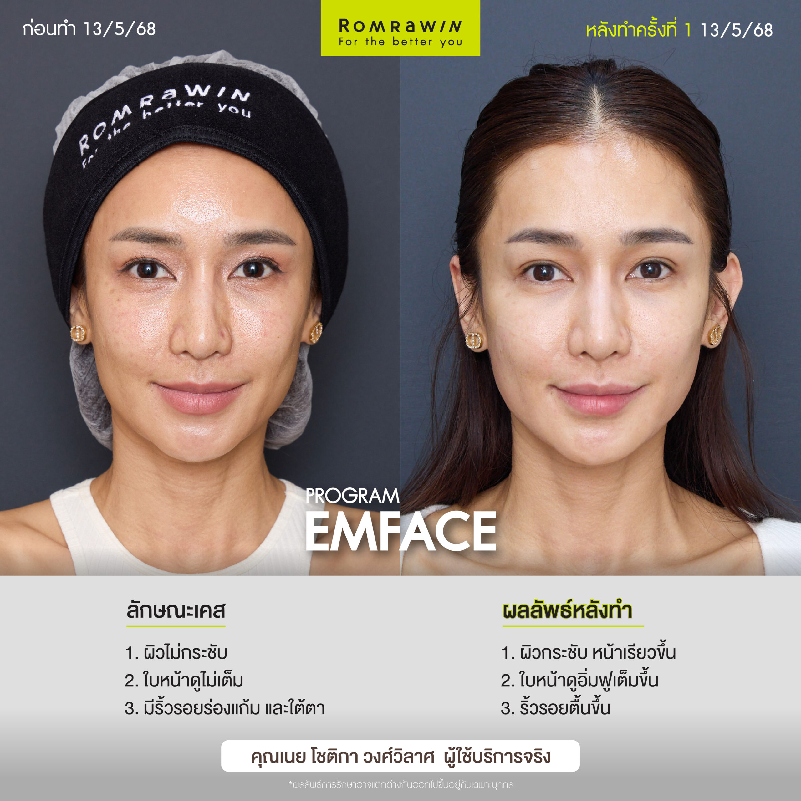 ผลลัพธ์ขึ้นอยู่กับแต่ละบุคคล