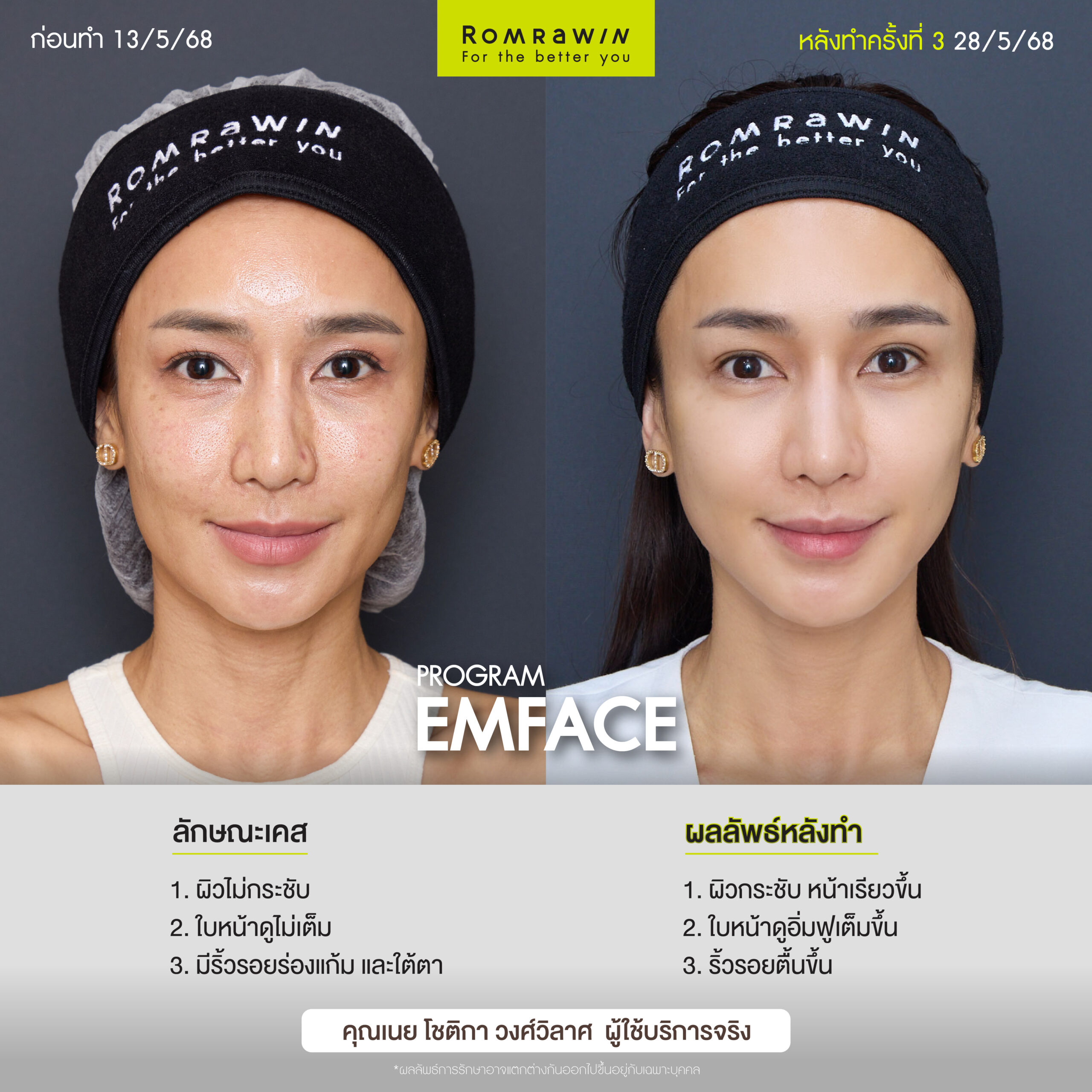 ผลลัพธ์ขึ้นอยู่กับแต่ละบุคคล