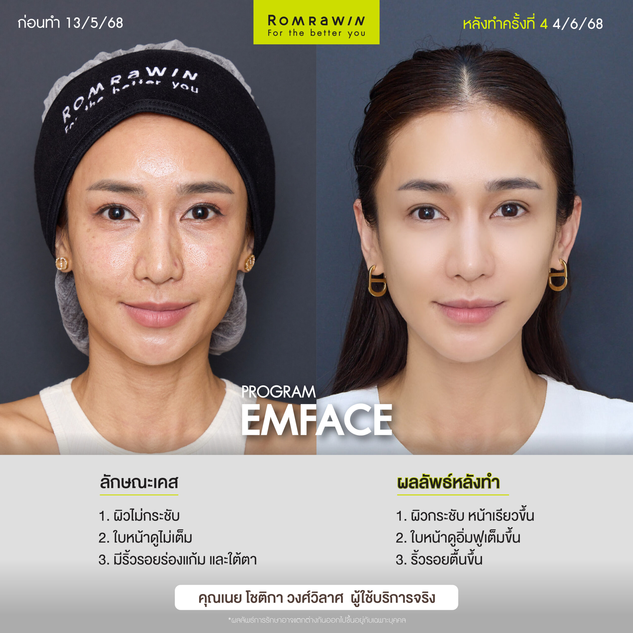 ผลลัพธ์ขึ้นอยู่กับแต่ละบุคคล