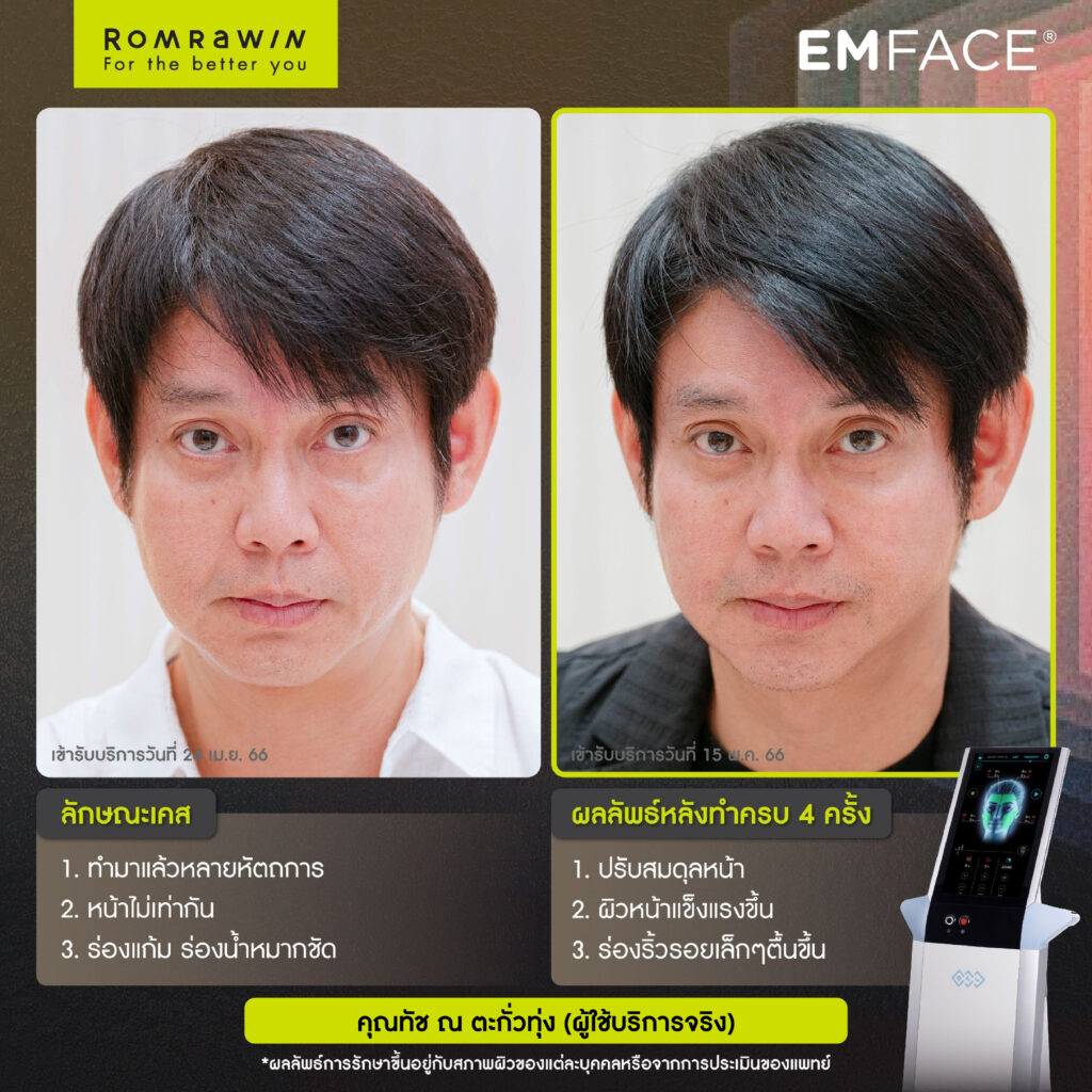Emface คุณทัช ณ ตะกั่วทุ่ง ผู้ใช้บริการจริง