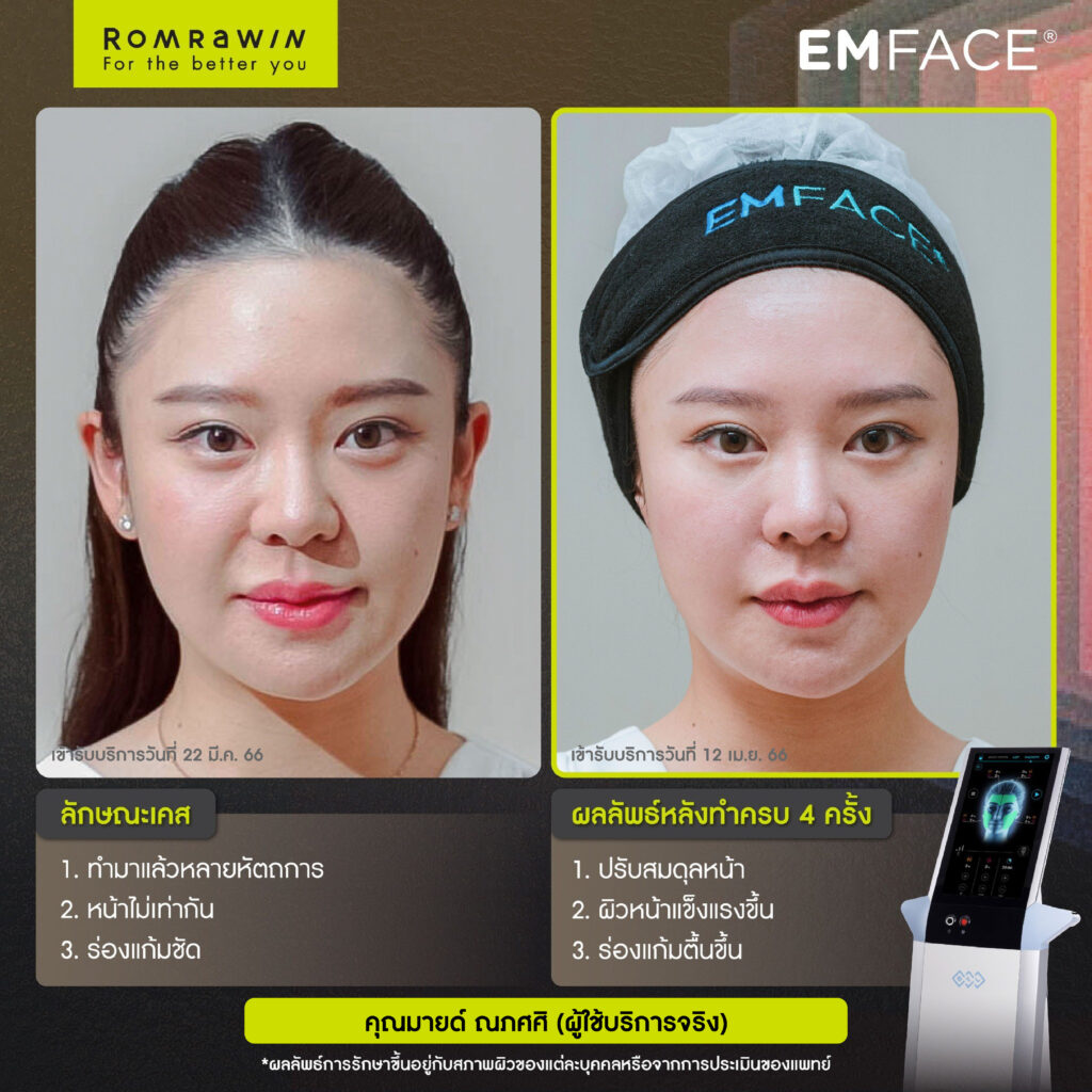 Emface คุณมาย ณภัศศิ ผู้ใช้บริการจริง