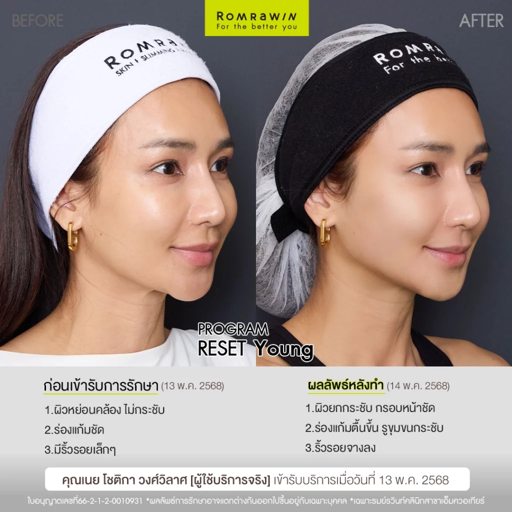 ผลลัพธ์ขึ้นอยู่กับแต่ละบุคคล