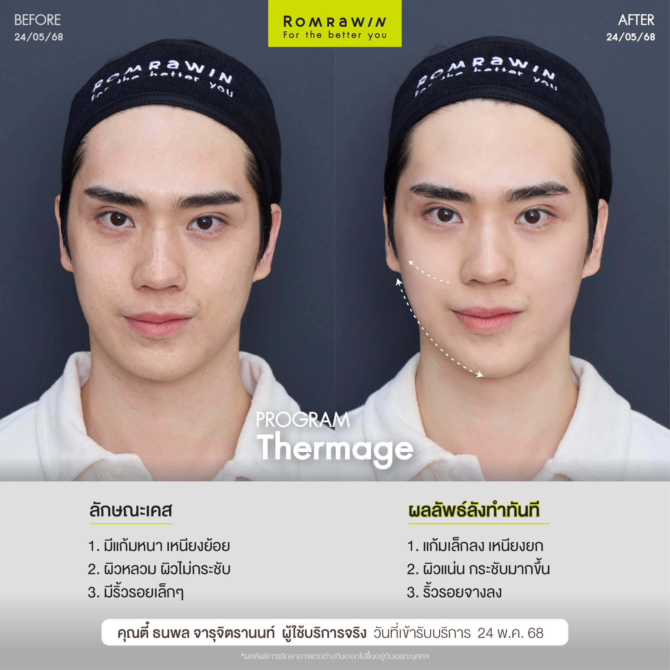 ผลลัพธ์ขึ้นอยู่กับแต่ละบุคคล