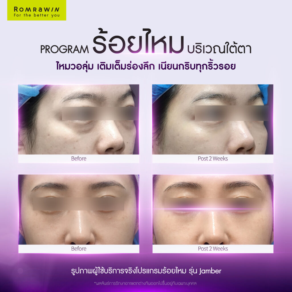ร้อยไหม (Thread lift) คืออะไร มีกี่ประเภท อันตรายไหม 12 ผลลัพธ์ขึ้นอยู่กับแต่ละบุคคล