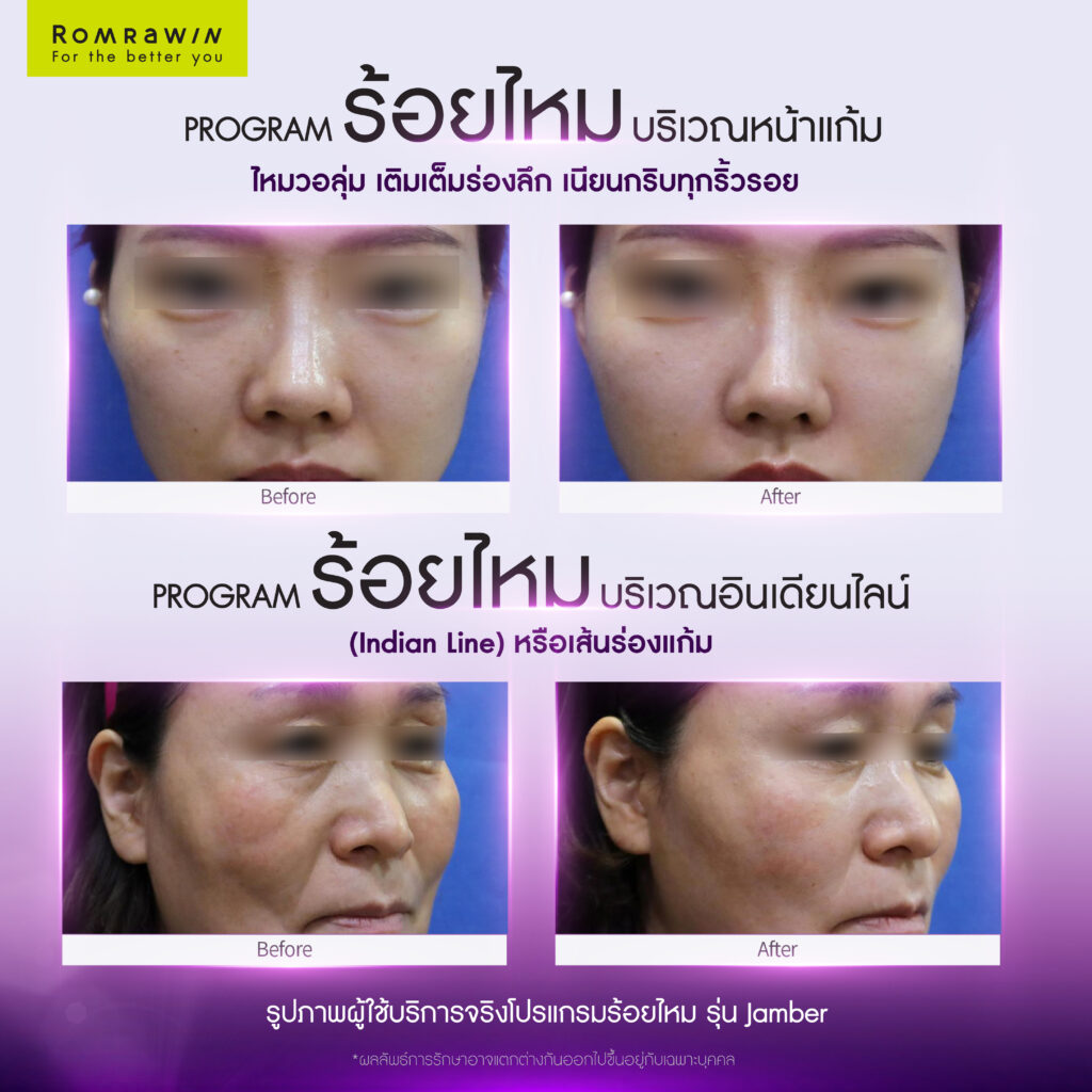 ร้อยไหม (Thread lift) คืออะไร มีกี่ประเภท อันตรายไหม 11 ผลลัพธ์ขึ้นอยู่กับแต่ละบุคคล