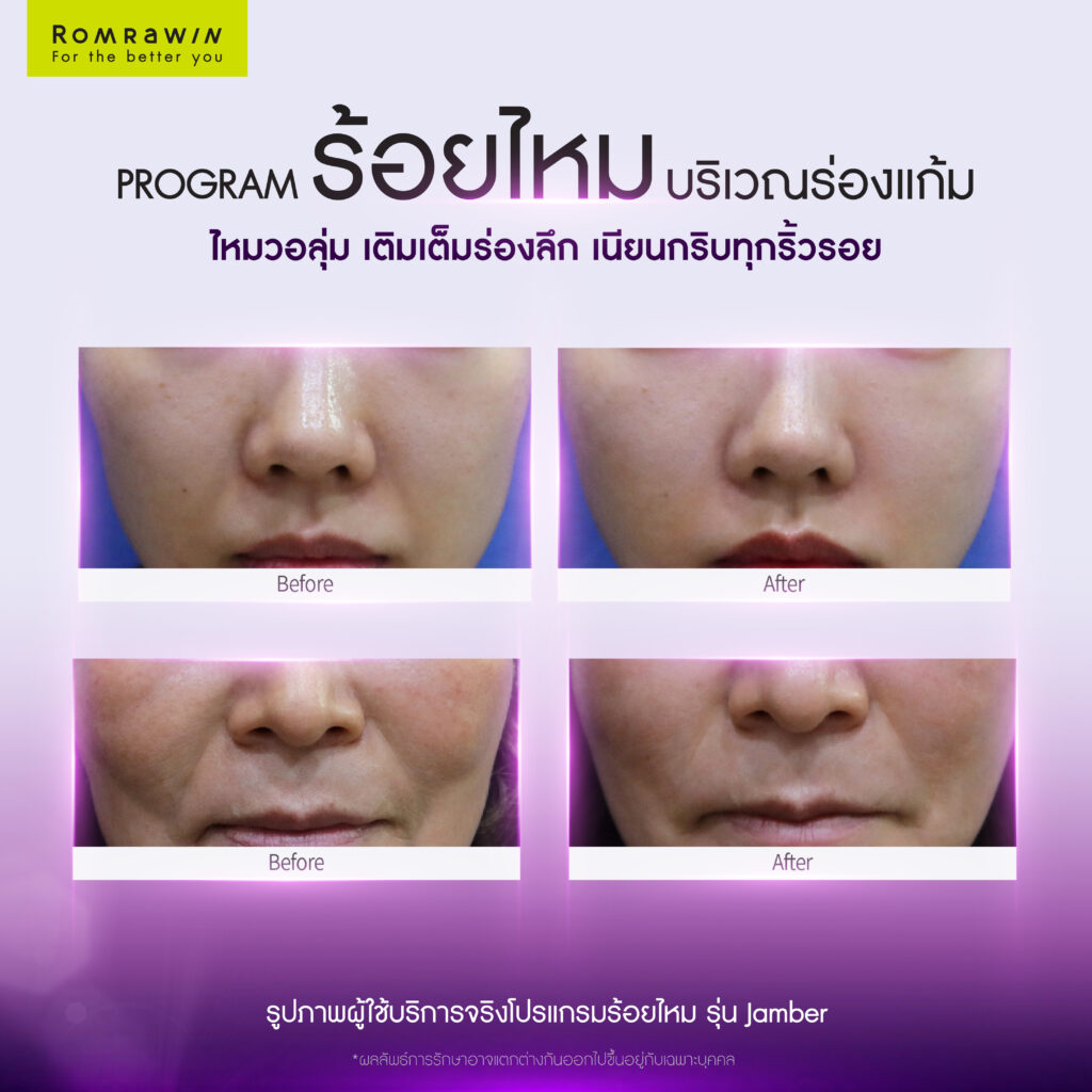 ร้อยไหม (Thread lift) คืออะไร มีกี่ประเภท อันตรายไหม 13 ผลลัพธ์ขึ้นอยู่กับแต่ละบุคคล