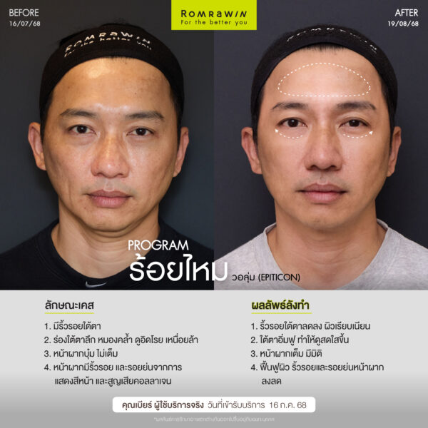 ร้อยไหม (Thread lift) คืออะไร มีกี่ประเภท อันตรายไหม 2 ผลลัพธ์ขึ้นอยู่กับแต่ละบุคคล
