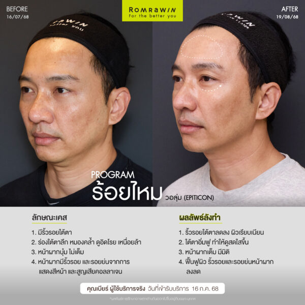 ร้อยไหม (Thread lift) คืออะไร มีกี่ประเภท อันตรายไหม 3 ผลลัพธ์ขึ้นอยู่กับแต่ละบุคคล