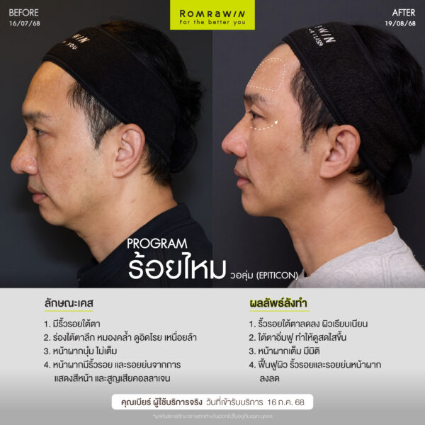 ร้อยไหม (Thread lift) คืออะไร มีกี่ประเภท อันตรายไหม 5 ผลลัพธ์ขึ้นอยู่กับแต่ละบุคคล