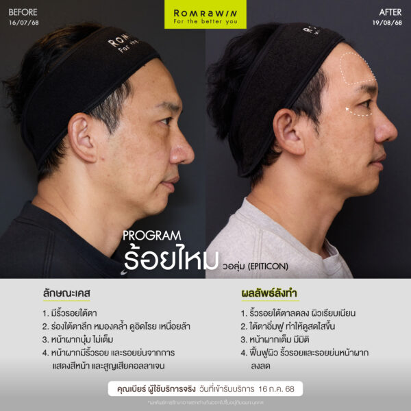 ร้อยไหม (Thread lift) คืออะไร มีกี่ประเภท อันตรายไหม 4 ผลลัพธ์ขึ้นอยู่กับแต่ละบุคคล