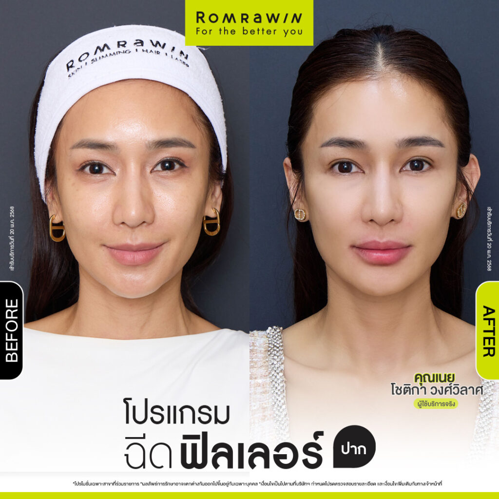 ผลลัพธ์ขึ้นอยู่กับแต่ละบุคคล