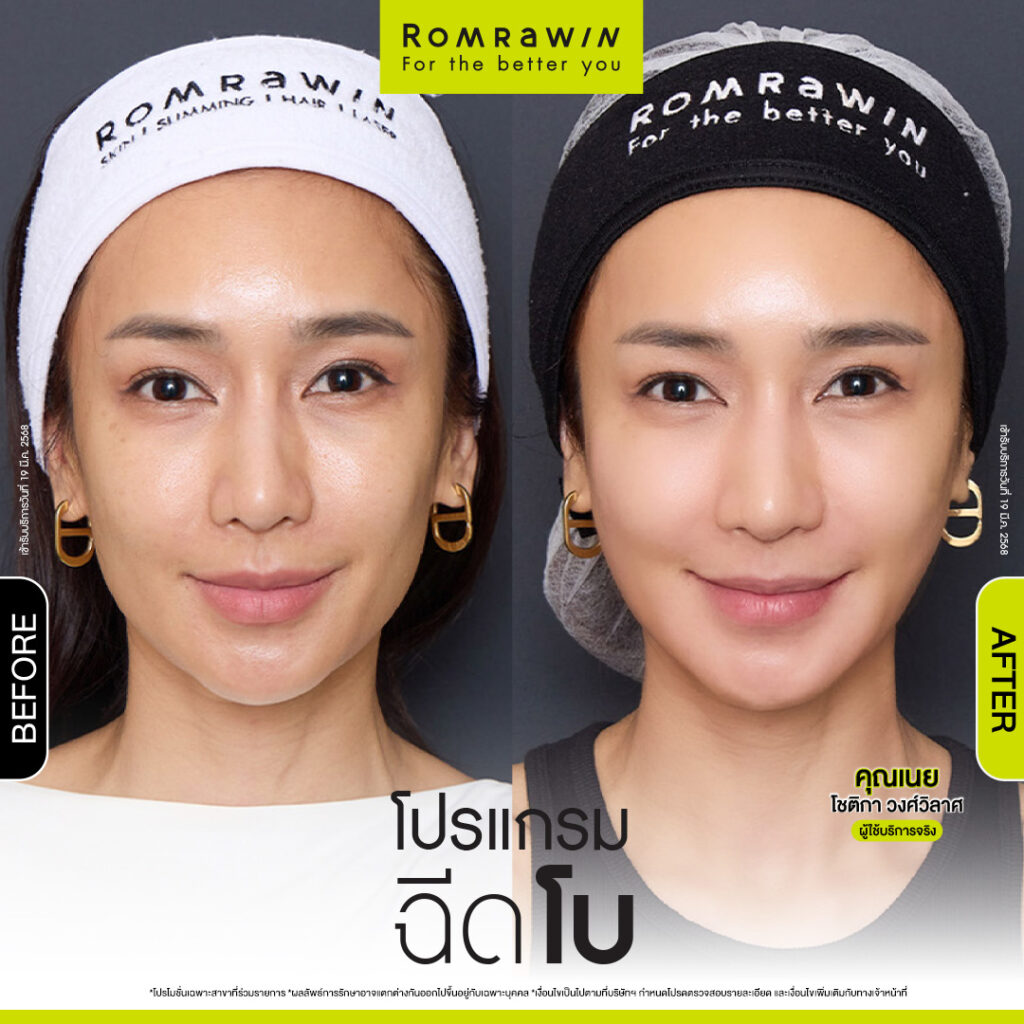 ฉีดโบเพื่ออะไร เห็นผลหรือไม่ ทำไมต้องฉีด ข้อควรรู้ในการฉีดโบ 2 ผลลัพธ์ขึ้นอยู่กับแต่ละบุคคล