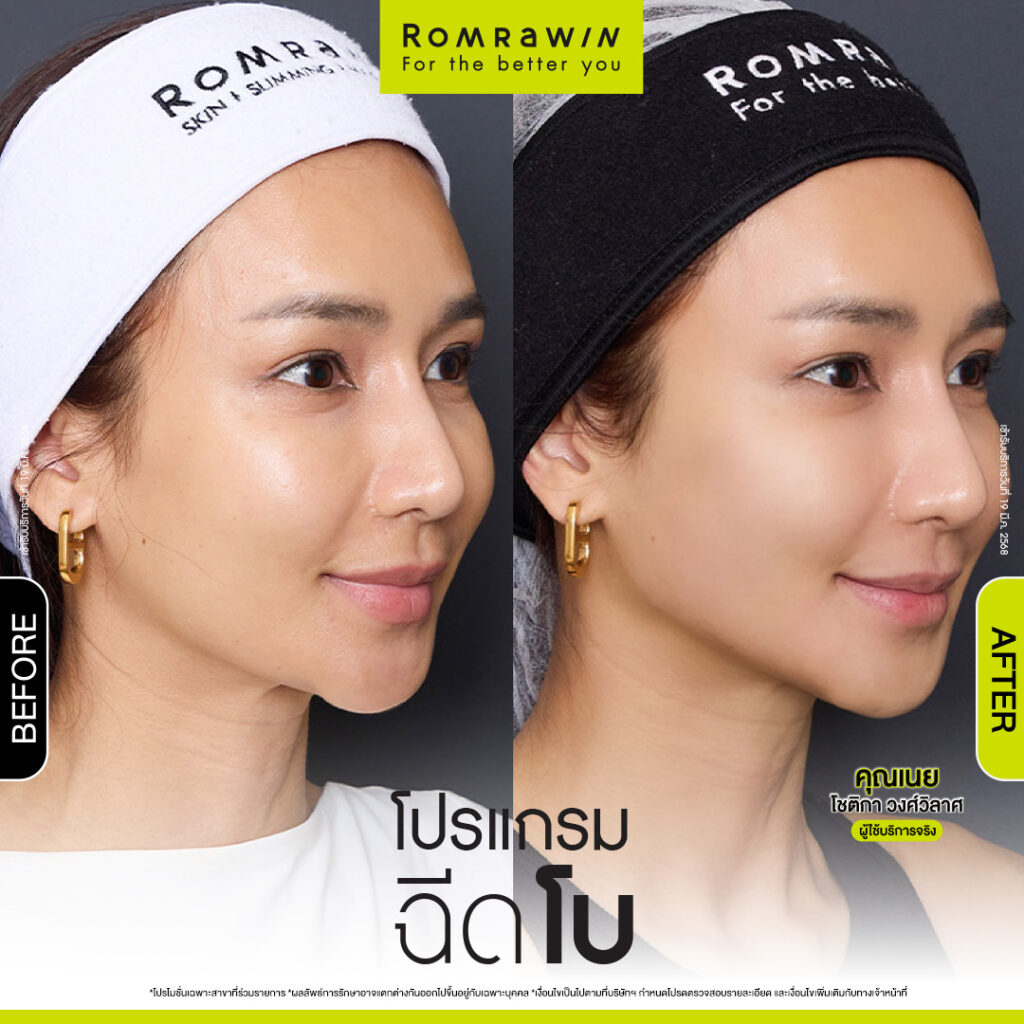 ฉีดโบเพื่ออะไร เห็นผลหรือไม่ ทำไมต้องฉีด ข้อควรรู้ในการฉีดโบ 3 ผลลัพธ์ขึ้นอยู่กับแต่ละบุคคล