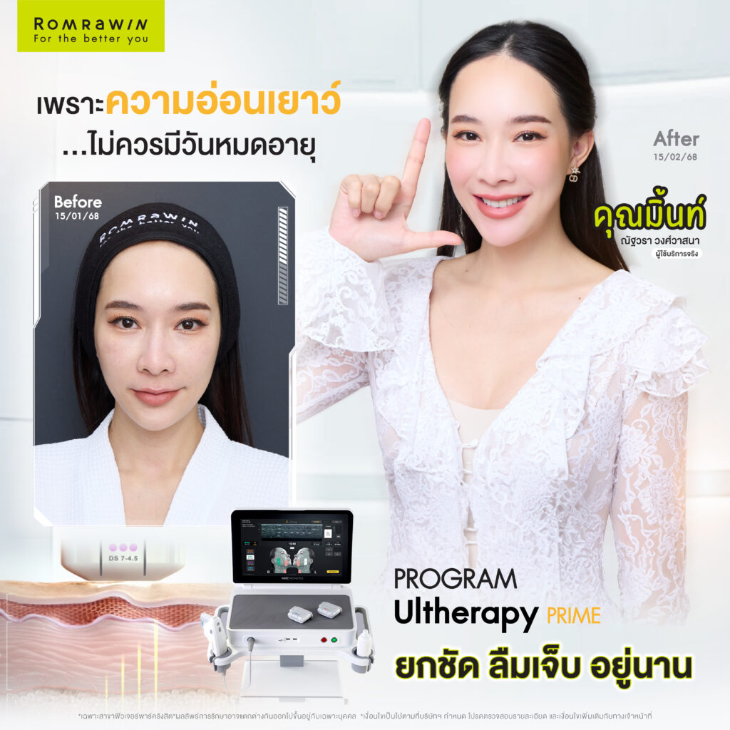 มิ้นท์ ณัฐวรา โปรแกรม Ultherapy Prime
