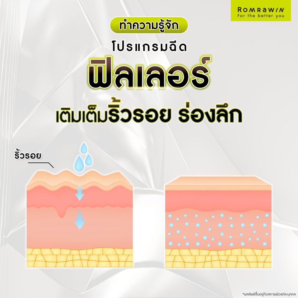 ทำความรู้จัก โปรแกรมฉีดฟิลเลอร์เติมเต็มริ้วรอย