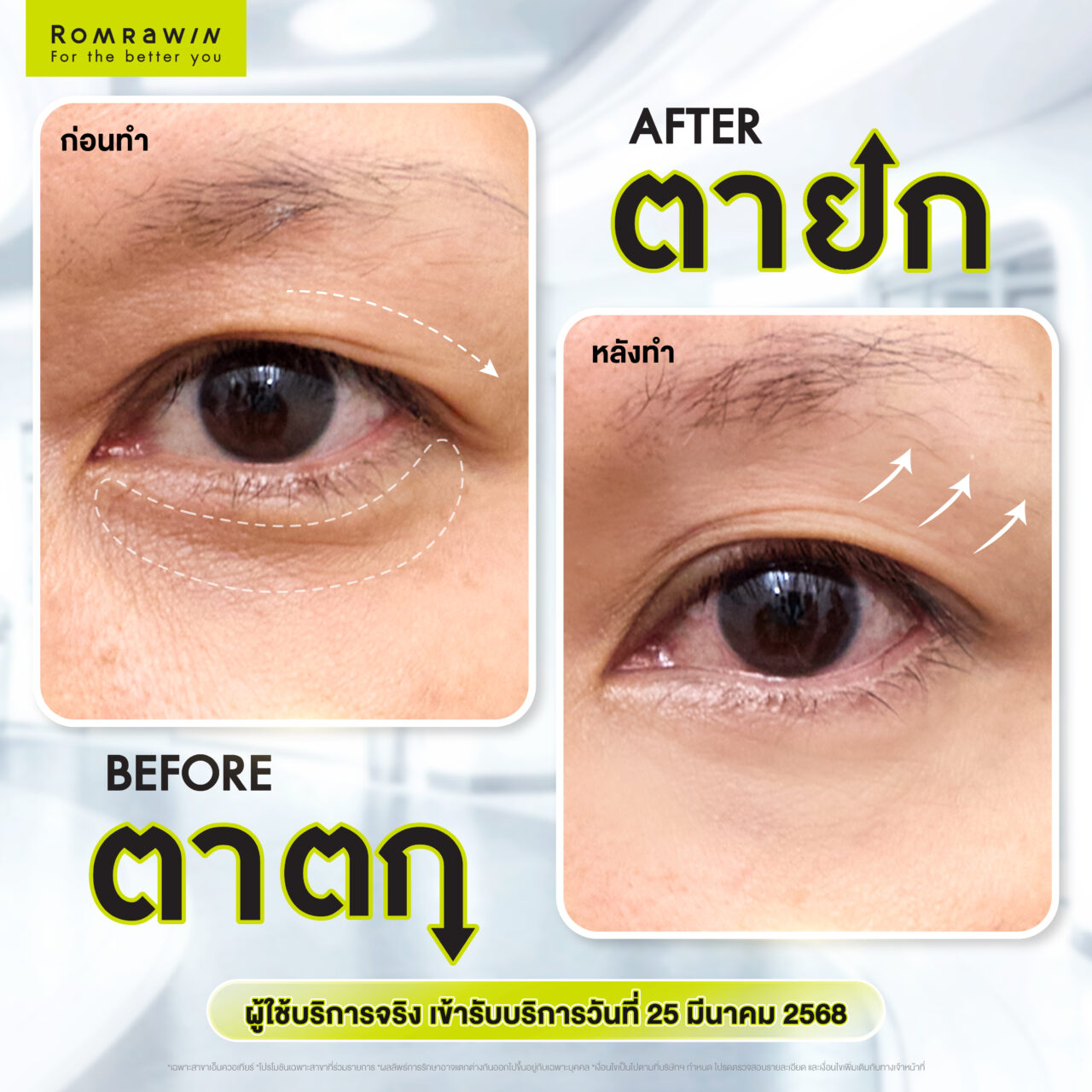 Thermage for Eye 