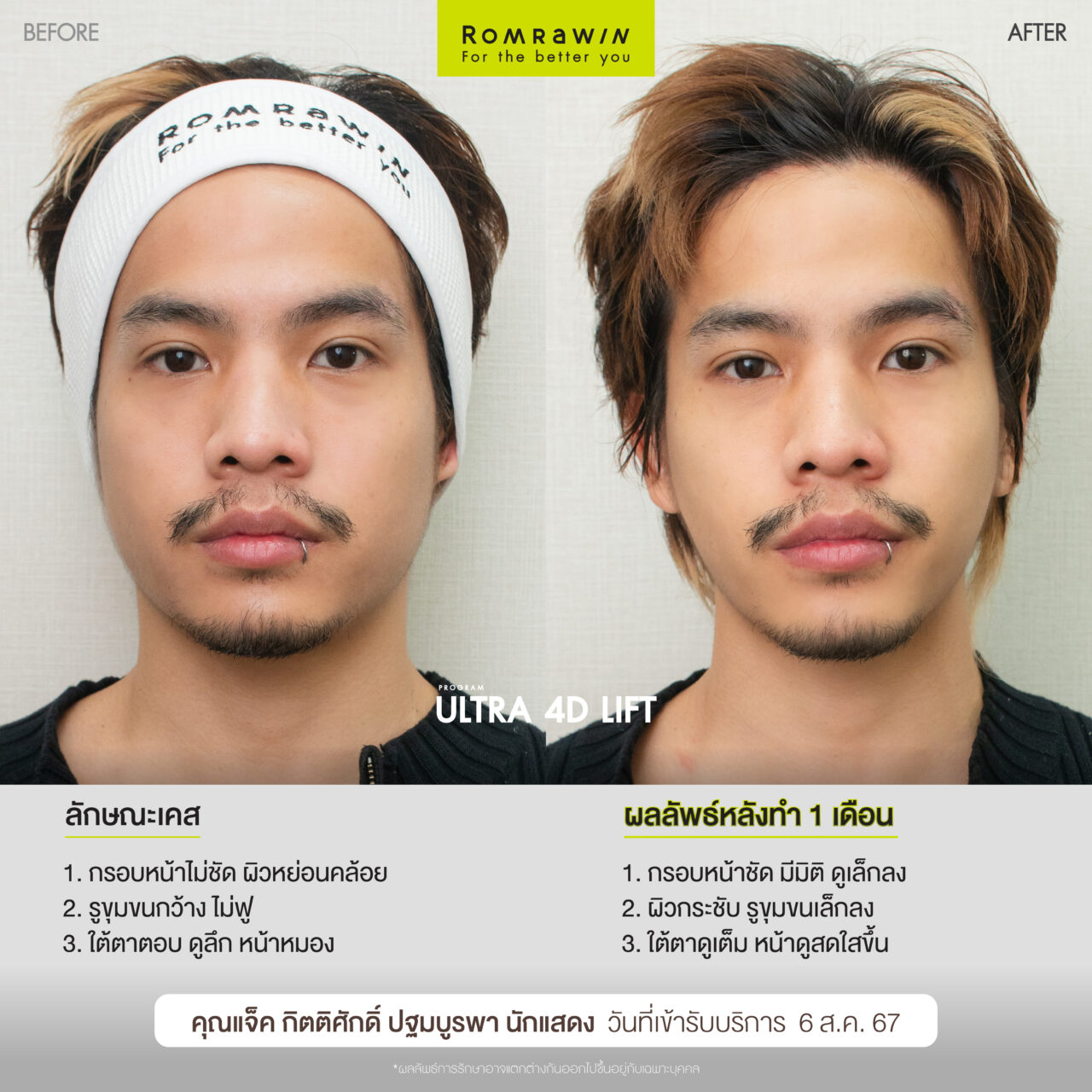 Ultraformer MPT กรอบชัด หน้ายก ครบที่เดียว 