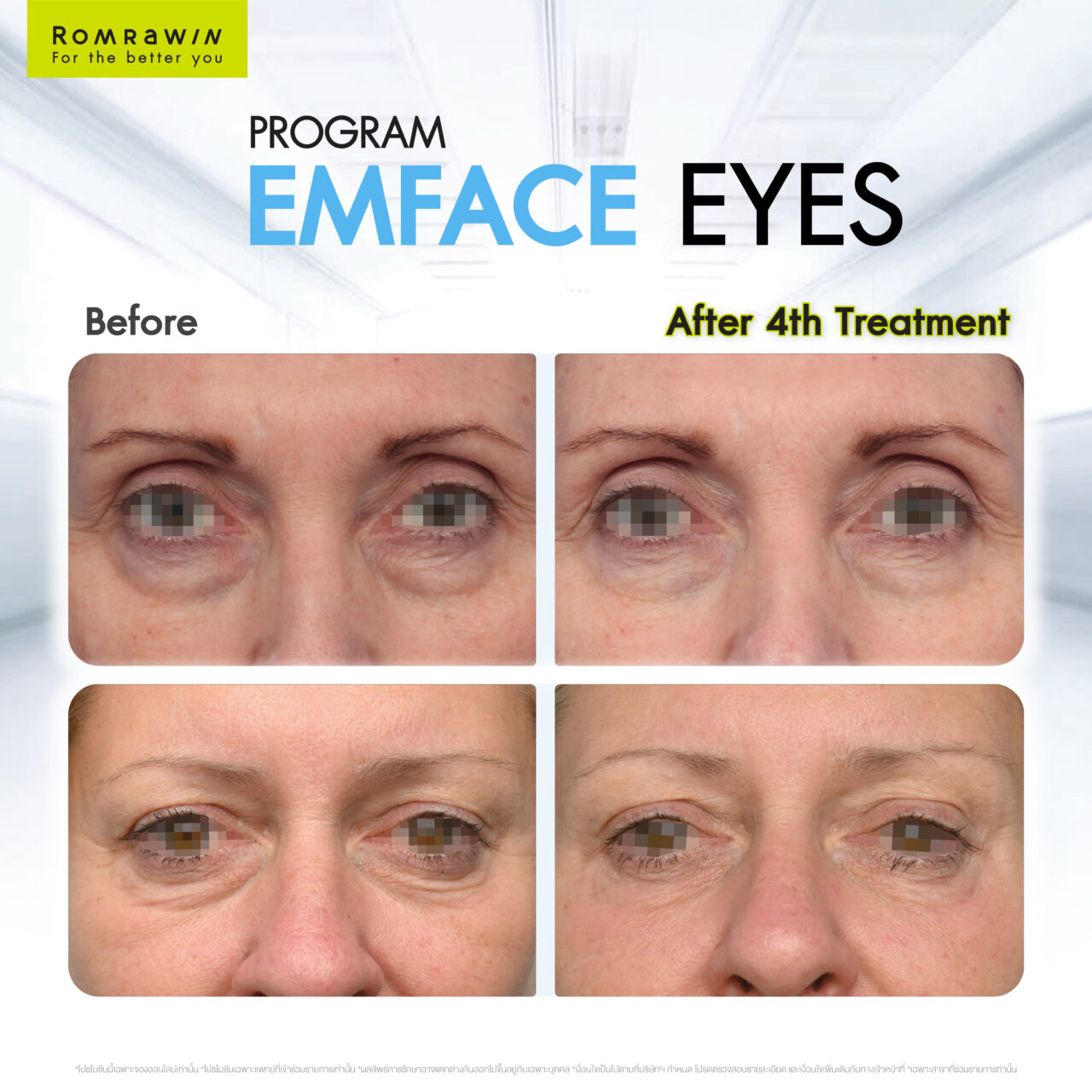 Emface Eyes ผสาน 2 เทคโนโลยีเพื่อผิวใต้ตาเฟิร์ม กระจ่างใส ดูอ่อนเยาว์ 7 Emface EYE