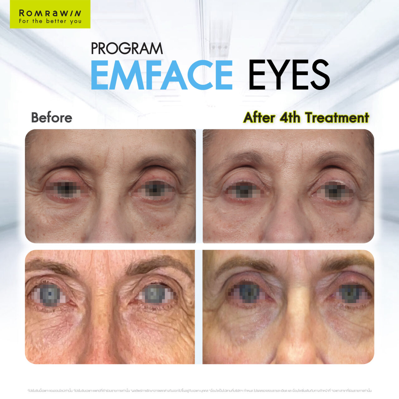 Emface Eyes ผสาน 2 เทคโนโลยีเพื่อผิวใต้ตาเฟิร์ม กระจ่างใส ดูอ่อนเยาว์ 8 Emface EYE