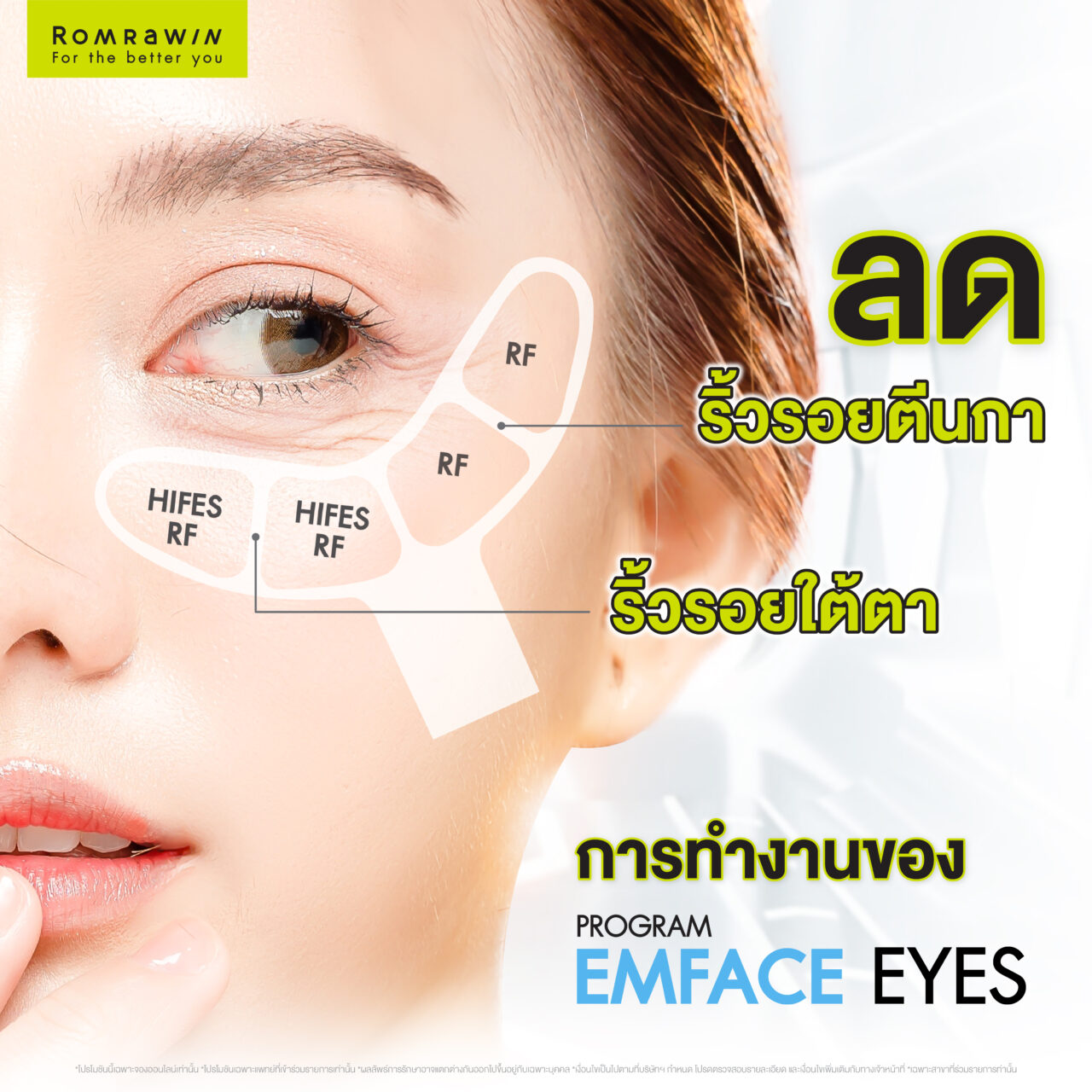 Emface Eyes ผสาน 2 เทคโนโลยีเพื่อผิวใต้ตาเฟิร์ม กระจ่างใส ดูอ่อนเยาว์ 3 Emface Eyes ยกกระชับผิวในแต่ละชั้นได้อย่างไร?