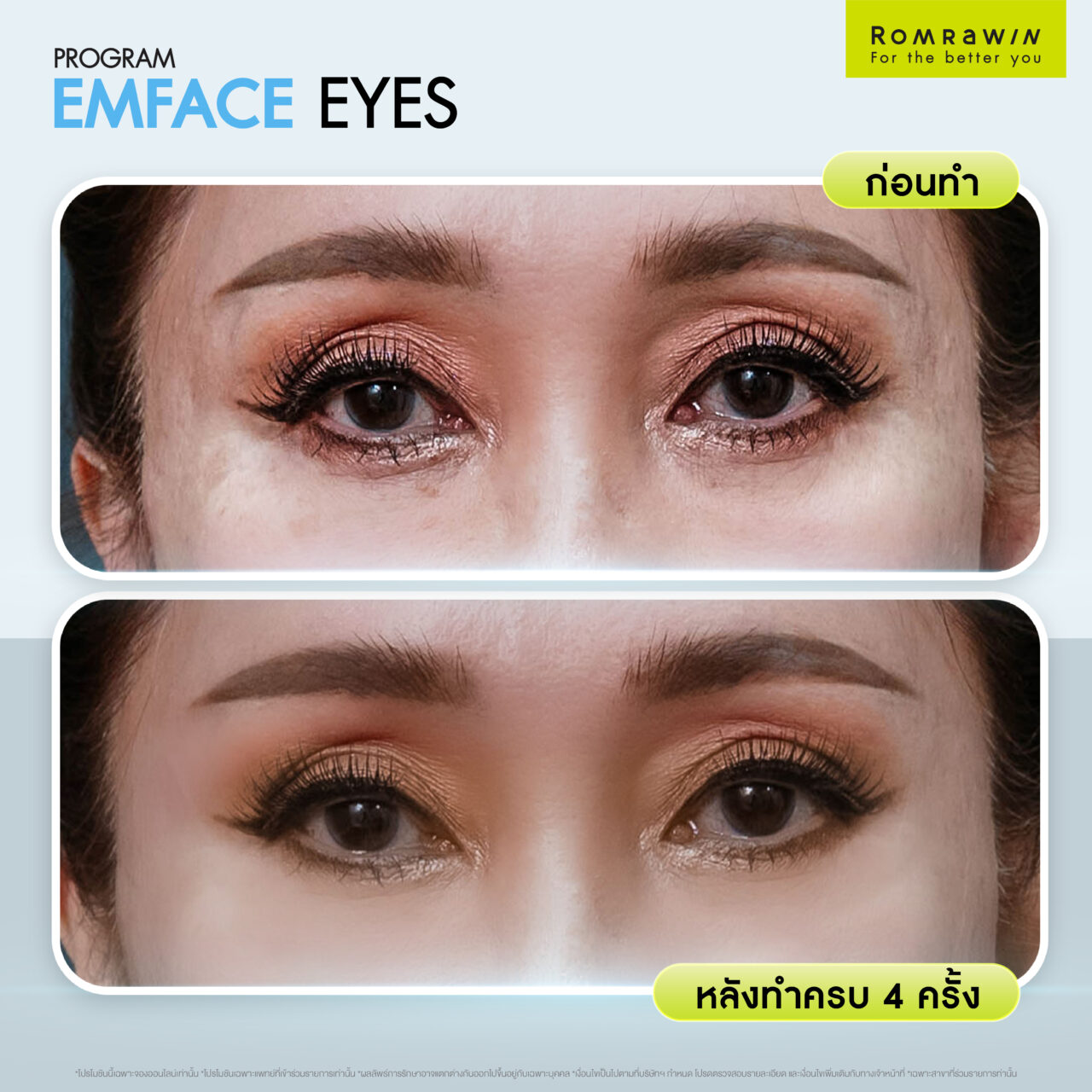 Emface Eyes