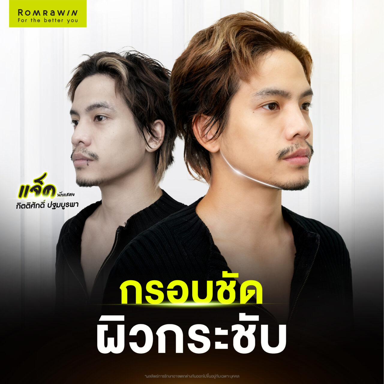 Ultraformer MPT กรอบชัด หน้ายก ครบที่เดียว 