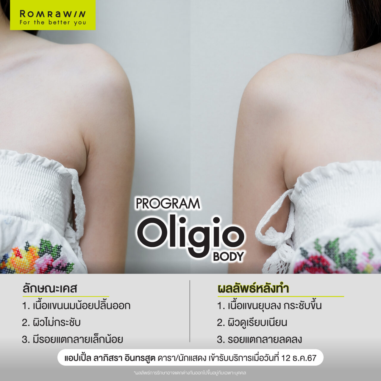 Oligio Body เลิกปลิ้น เปลี่ยนหุ่นให้เชพดี คุณแอปเปิ้ล ลาภิสรา