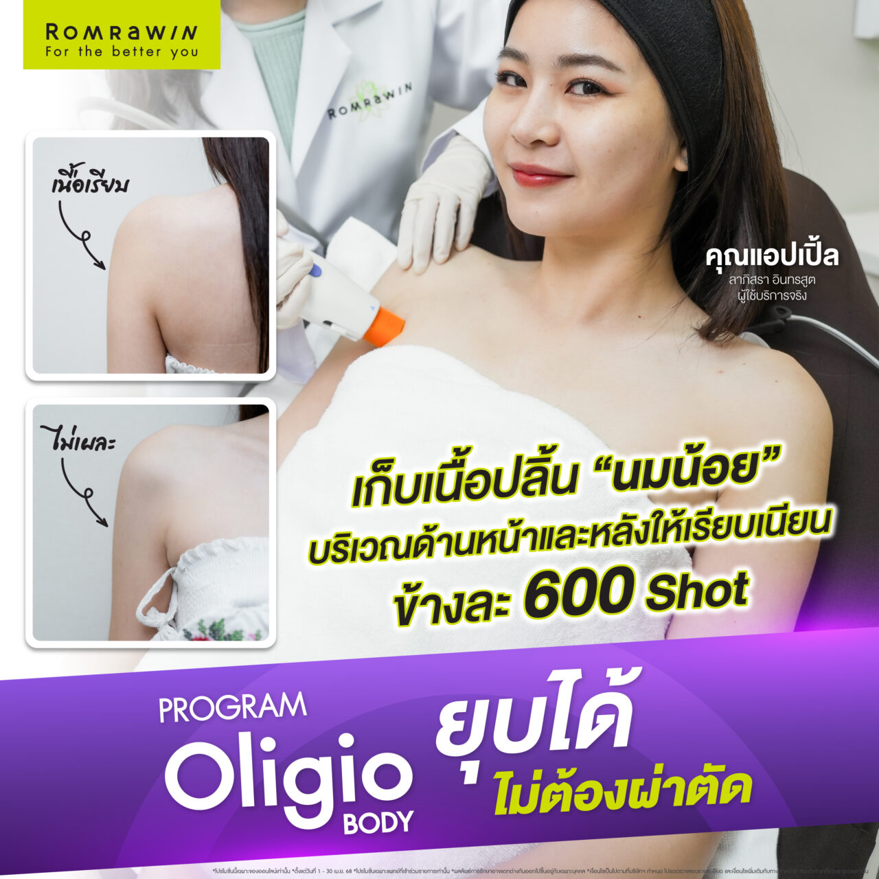 Oligio Body เลิกปลิ้น เปลี่ยนหุ่นให้เชพดี คุณแอปเปิ้ล ลาภิสรา