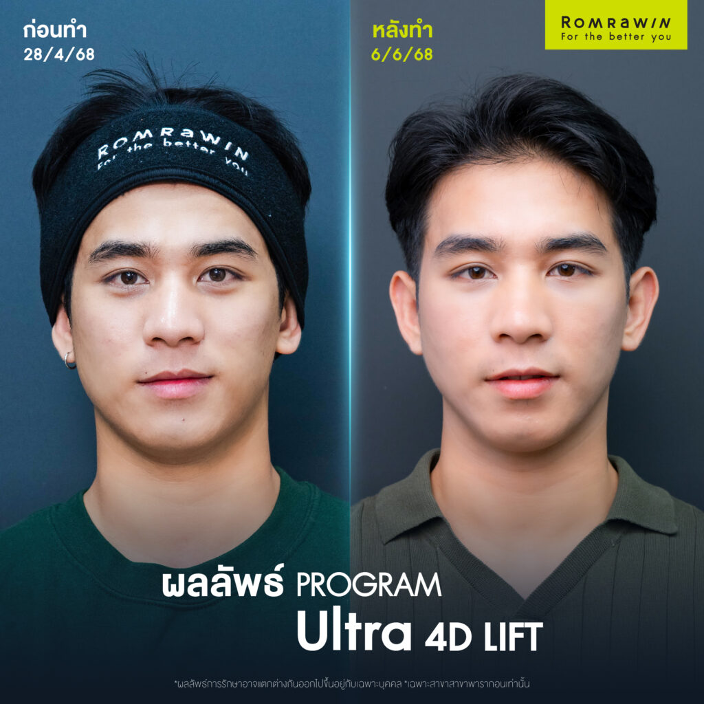 กรอบหน้าชัด Ultra 4D LIFT