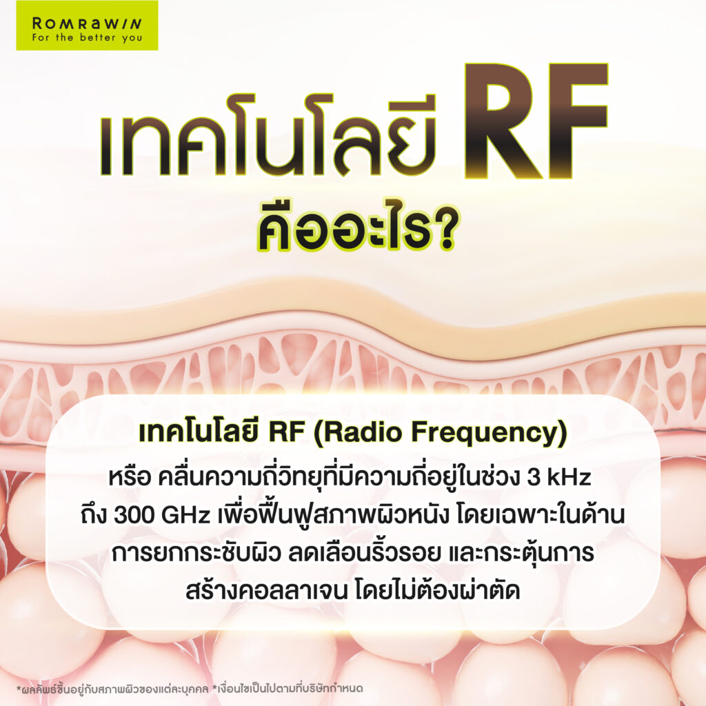 ทำความรู้จักเทคโนโลยี RF (Radio Frequency)
