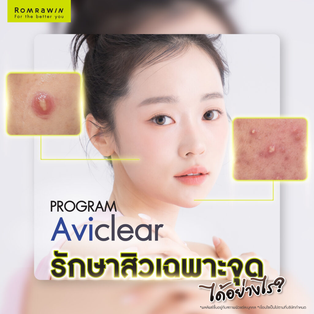 Aviclear รักษาสิวเฉพาะจุดได้อย่างไร ?