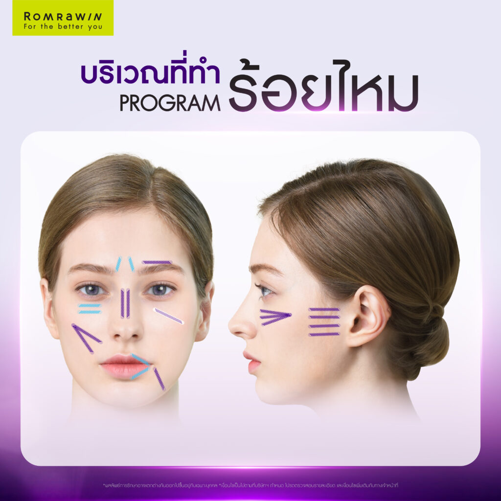 ไหม Epiticon ไหมเพิ่มวอลลุ่มเติมเต็มร่องลึก เนียนกริบทุกริ้วรอย 6 ไหม Epiticon ไหมเพิ่มวอลลุ่ม Jamber (ไหมเรียบทรงเกลียว)