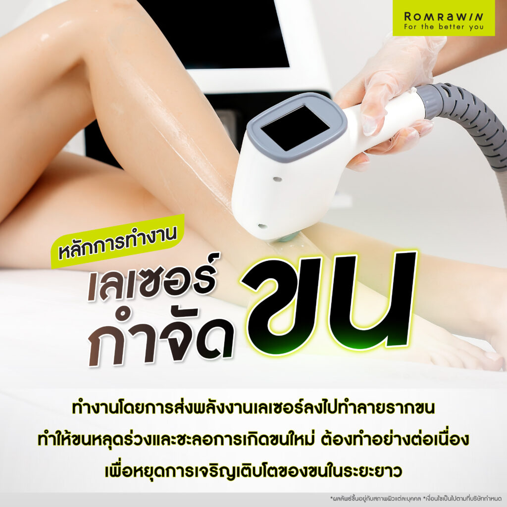การทำงานของเลเซอร์กำจัดขน