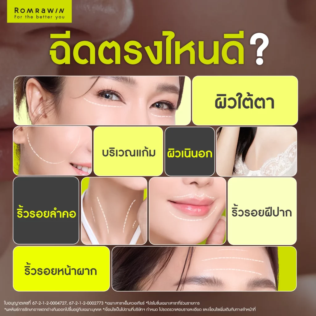 Plinest ฉีดตรงไหนดี ?