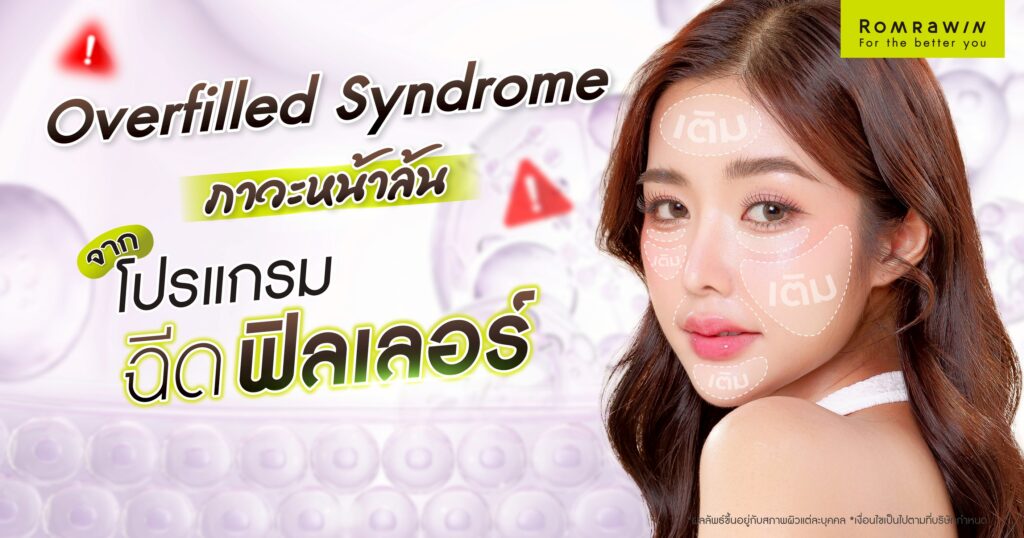 Overfilled Syndrome ภาวะหน้าล้นจากฟิลเลอร์ คืออะไร? เกิดจากอะไร? 1 Overfilled Syndrome