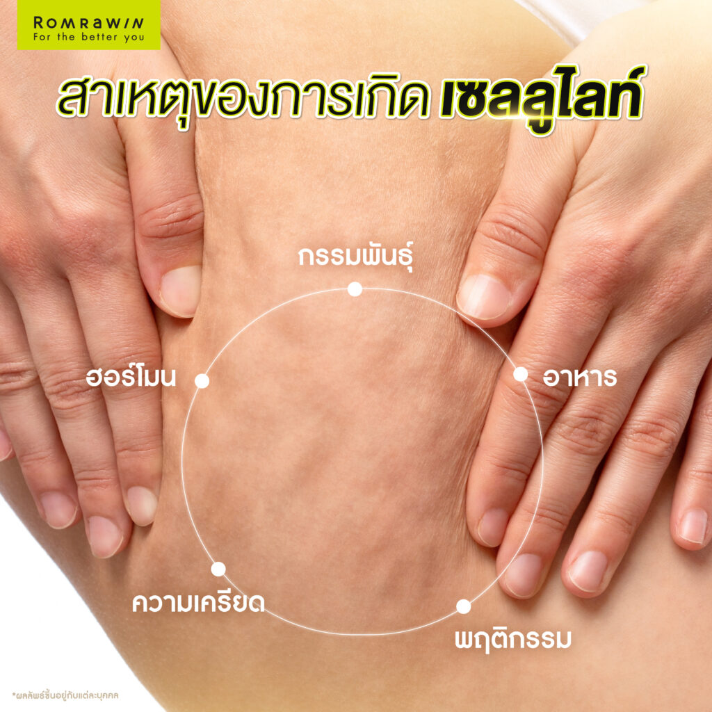 เซลลูไลท์ คืออะไร? รู้จักต้นตอของปัญหา พร้อมวิธีลดเซลลูไลท์ดูแลผิวให้กระชับ 3 สาเหตุของการเกิดเซลลูไลท์