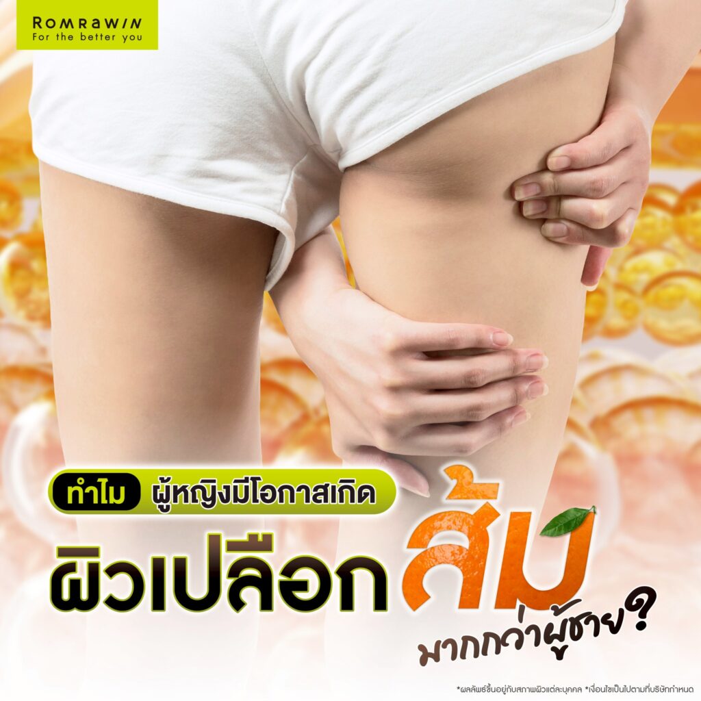 ผิวเปลือกส้ม เกิดจากอะไร? สาเหตุของปัญหาผิว พร้อมตัวช่วยให้ผิวเรียบเนียน 5 ทำไมผู้หญิงมีโอกาสเกิดผิวเปลือกส้มมากกว่าผู้ชาย?