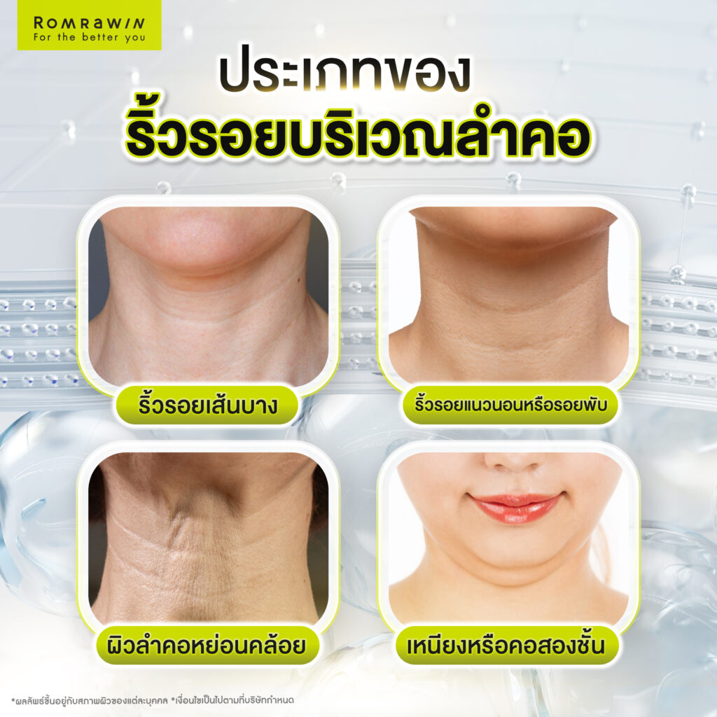 คอเหี่ยว คอย่น ริ้วรอยลำคอ ยกกระชับคอด้วยวิธีไหนดี 3 ประเภทของริ้วรอยและความหย่อนคล้อยของลำคอ