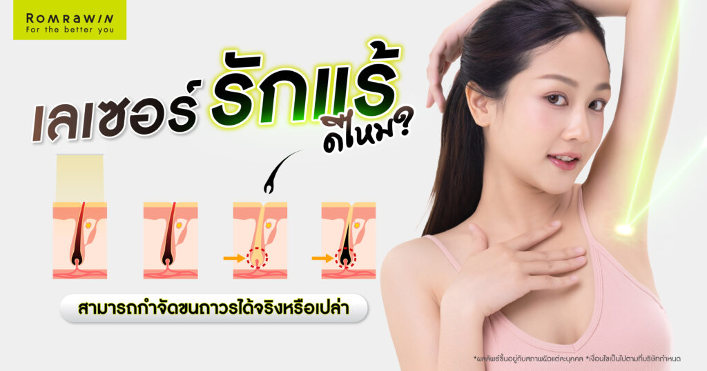 เลเซอร์รักแร้ดีไหม