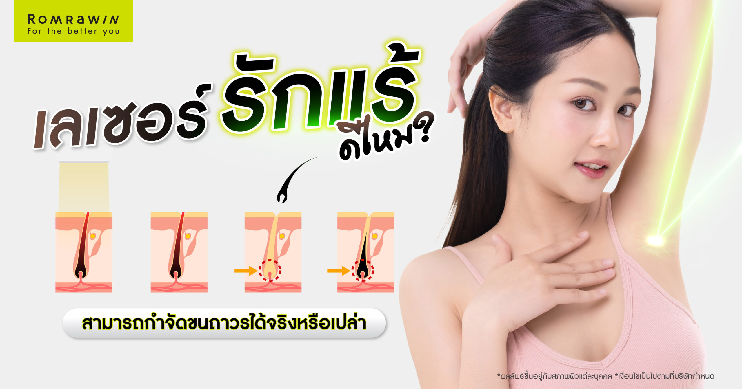 เลเซอร์รักแร้ดีไหม