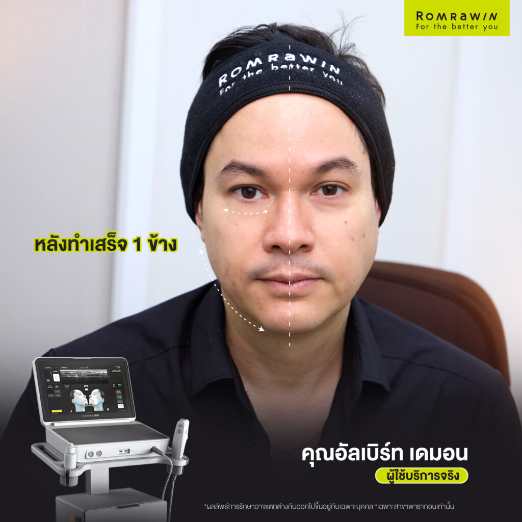 Ultherapy PRIME คุณอัลเบิร์ท เดมอน เสริมลุคให้ดูดี 3 Ultherapy PRIME คุณอัลเบิร์ท เดมอน