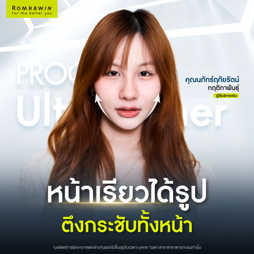 ลาก่อนแก้มอ้วน เพราะ Ultraformer MPT 4D  LIFT ช่วยจัดการให้หน้าเรียว 