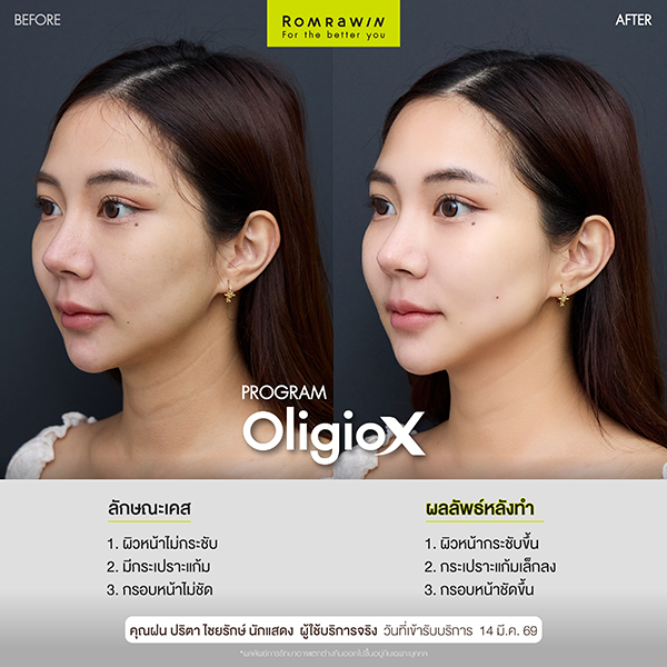 ผลลัพธ์ขึ้นอยู่กับแต่ละบุคคล