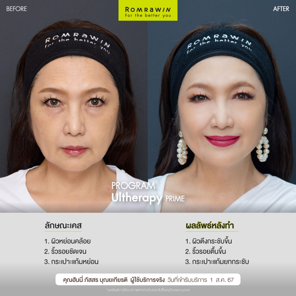 Ultherapy PRIME คุณฮันนี่ทวงคืนความสวย และความสุขให้ตัวเอง