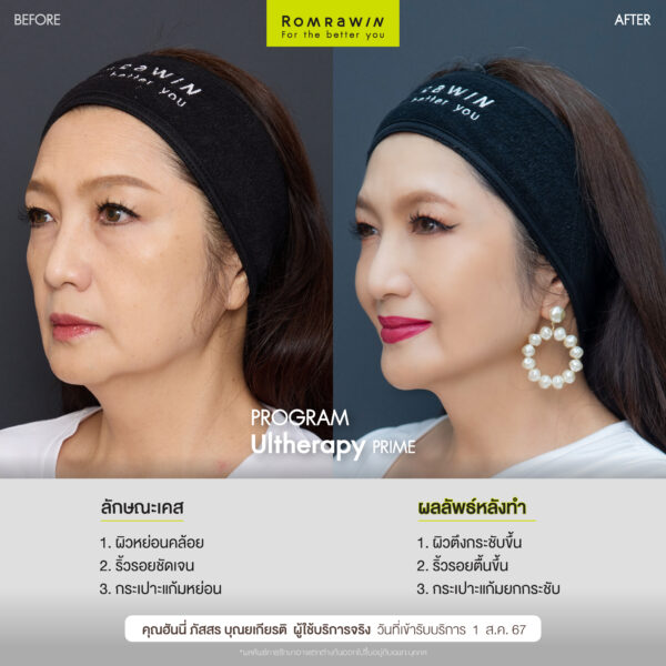 Ultherapy PRIME คุณฮันนี่