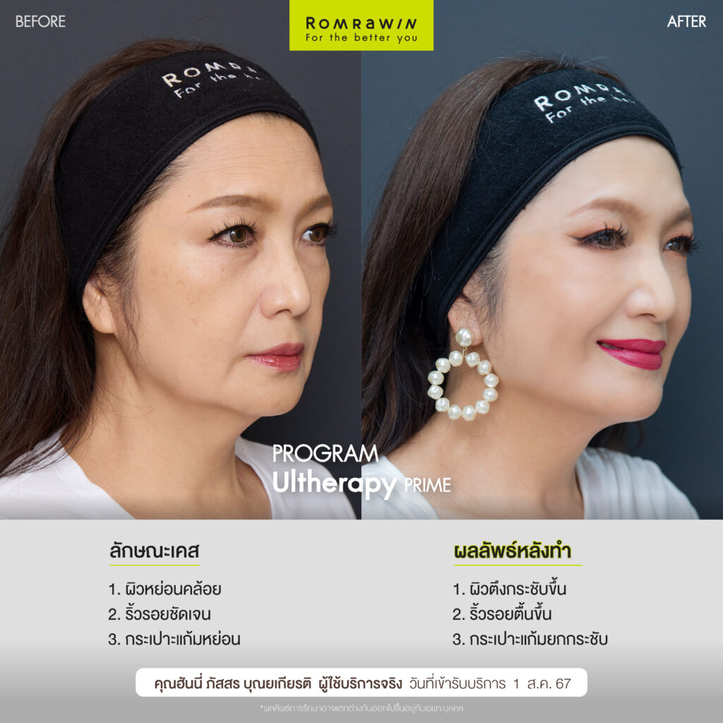 Ultherapy PRIME คุณฮันนี่