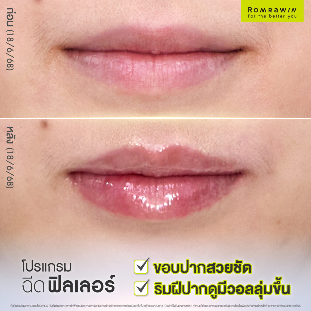 โปรแกรมฉีดฟิลเลอร์ปากเติมวอลลุ่มให้ปากดูมีมิติ ไม่เว่อร์