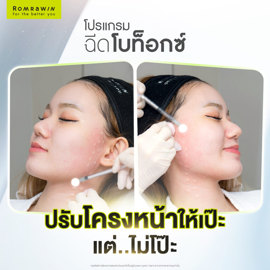 ฉีดโบลิฟหน้าเรียว
