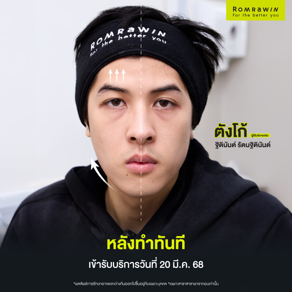 คุณตังโก้ Ultraformer MPT 4D LIFT กรอบหน้าชัดแบบผู้ชายสมัยใหม่ 