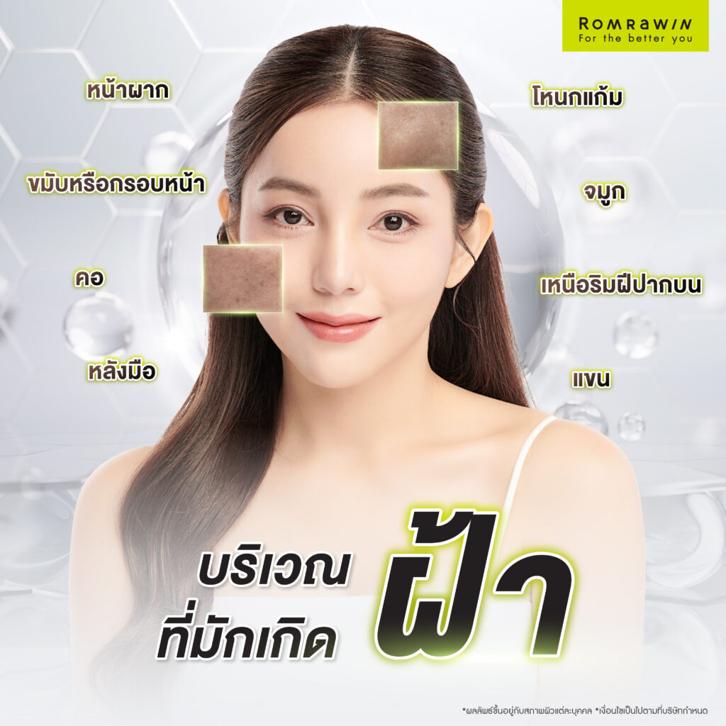 บริเวณที่มักเกิดฝ้า